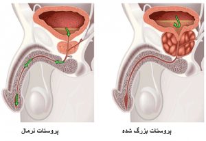 غده پروستات بزرگ شده